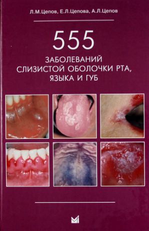 Цепов Л.М. 555 заболеваний слизистой оболочки рта, языка и губ / 2-е изд.