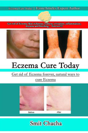 Smit Chacha Eczema Cure Today - Get rid of Eczema forever natural ways to cure Eczema