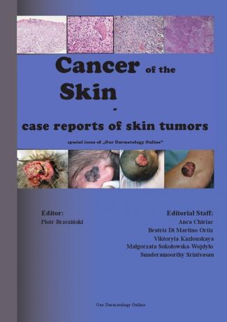 Piotr Brzezinski Cancer of the Skin - case reports of skin tumors